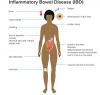 Photo for Inflammatory Bowel Disease Treatment Market is anticipated to reach USD 22.4 billion by 2026
