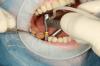 Photo for Osseointegration Implants Market Size, Share, Growth, Trends and Industry Analysis Report, 2018 to 2026