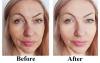 Photo for Laser resurfacing