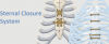 Photo for Sternal Closure Systems Market Size Worth $3.12 Billion By 2026