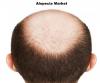 Photo for Alopecia Market Size, Analysis, Statistics, Trends, Forecast Report, 2026