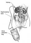 Photo for Nephrostomy Devices Market Size, Share, Growth and Trend Analysis Report, 2019 to 2026