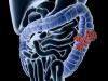 Photo for Global Colorectal Cancer Market 2020 | Manufacturers, Regions, Type and Application, Forecast to 2025