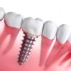 Photo for Global Bio-Implants Market Research Report - Industry Analysis, Size, Share, Growth, Trends and Forecast Till 2026