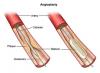 Photo for Coronary Stent Market Will Rise Due to Enhanced Bioengineered Absorbable Products