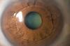 Photo for Global Verisyse Lens Market 2020 | Manufacturers, Regions, Type and Application, Forecast to 2025