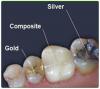 Photo for Global Tooth Filling Materials Market 2020 | Manufacturers, Regions, Type and Application, Forecast to 2025