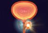 Photo for Global Brachytherapy Market Research Report - Industry Analysis, Size, Share, Growth, Trends and Forecast Till 2026