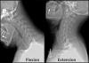 Photo for Cervical Radiculopathy Treatment Market 2019 Price By Revenue, Regional Outlook And Consumption