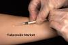 Photo for Tuberculin Market Business Analysis, Scope, Size, Trends, Demand, Overview, Forecast 2028