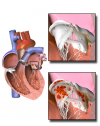 Photo for Pacemaker Infection Treatment Drugs Market 2019 Share, Growth Rate, Sales Value And Industry Production Volume