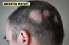 Photo for Global Alopecia Market Size Estimated To Observe Significant Growth By 2027