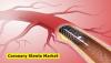 Photo for Coronary Stents Market Research Report, Popular Trends & Technological Advancements & Forecast To 2027