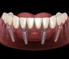 Photo for Smile Makeover in an Francisco Bay Area