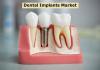 Photo for Dental Implants Market Demands, Types And Projected Industry Size & Shares 2027