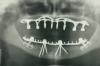 Photo for Demand for Peek Dental Implants to be Fueled by Changes in Consumer Perception in the Light of COVID-19