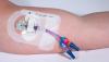 Photo for Global Catheter Stabilization Device Market Research Report - Industry Analysis, Size, Share, Growth, Trends and Forecast Till 2026