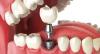 Photo for Global Dental Implants and Prosthetics Market Research Report - Industry Analysis, Size, Share, Growth, Trends and Forecast Till 2026