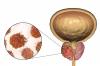 Photo for Global Prostate Cancer Diagnostics Market Research Report - Industry Analysis, Size, Share, Growth, Trends and Forecast Till 2026