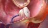 Photo for World Heart Defect Closure Devices Market: Market Size,Industry Growth and Forecast Report Till 2022
