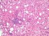 Photo for World Non-alcoholic Steatohepatitis Market: Market Size,Industry Growth and Forecast Report Till 2022