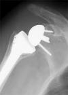 Photo for World Reverse Shoulder Arthroplasty Market: Market Size,Industry Growth and Forecast Report Till 2022