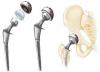 Photo for World Hip Replacement Implants Market: Market Size,Industry Growth and Forecast Report Till 2023