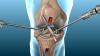 Photo for Small Joint Reconstructive Implants Market Growth Prospects, Key Vendors, and Future Scenario