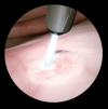 Photo for Global Plasma Surgery Market 2020 | Manufacturers, Regions, Type And Application, Forecast To 2025