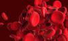 Photo for Global Sickle Cell Anemia Market Research Report - Industry Analysis, Size, Share, Growth, Trends and Forecast Till 2026