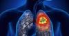 Photo for Global Pleural Effusions Treatment Market Research Report - Industry Analysis, Size, Share, Growth, Trends and Forecast Till 2026