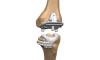 Photo for Global Orthopaedic Reconstruction Market Research Report - Industry Analysis, Size, Share, Growth, Trends and Forecast Till 2026