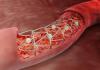 Photo for Global Arterial Stents Market 2020 | Manufacturers Regions Type And Application Forecast To 2025