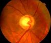 Photo for Proliferative Diabetic Retinopathy Market 2020-2024: Worldwide Industry Analysis, Market Share, Market Size and Forecast
