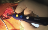 Photo for Global Electrosurgery Market Research Report - Industry Analysis, Size, Share, Growth, Trends and Forecast Till 2026