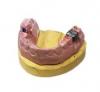 Photo for Global Dental Stone Market 2020 | Manufacturers Regions Type And Application Forecast To 2025