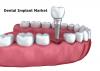 Photo for Dental Implant Market Size, Share, Growth, Strategies, Trends, Analysis And Forecast To 2024