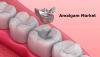 Photo for Amalgam Market Professional Survey Report Covers Leading Key Players Insights Till 2024