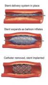 Photo for Global Coronary Stent Devices Market 2020 | Manufacturers Regions Type And Application Forecast To 2025