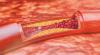 Photo for Global Atherosclerosis Market Research Report - Industry Analysis, Size, Share, Growth, Trends and Forecast Till 2026