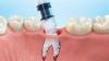 Photo for Global Dental Bone Graft Substitutes Market 2020 | Manufacturers, Regions, Type And Application, Forecast To 2025