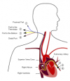 Photo for Global Pulmonary Artery Catheter Market 2020 | Manufacturers Regions Type And Application Forecast To 2025