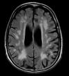 Photo for Global Multi Infarct Dementia Market Research Report - Industry Analysis, Size, Share, Growth, Trends and Forecast Till 2026