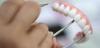 Photo for Global Indirect Restorative Materials of Dental Consumables Market 2020 | Manufacturers, Regions, Type And Application, Forecast To 2025