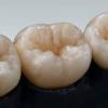 Photo for Global Zirconia Dental Material Market 2020 | Manufacturers, Regions, Type and Application, Forecast to 2025