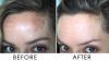 Photo for Global Hyperpigmentation Treatment Market 2020 | Manufacturers Regions Type And Application Forecast To 2025