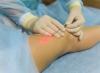 Photo for Global Laser Treatment Devices of Varicose Veins Market 2020 | Manufacturers Regions Type And Application Forecast To 2025
