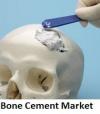 Photo for Bone Cements Market | World Players Forecast Analysis Till 2025