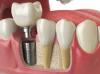 Photo for Global Dental Implant Market 2020 | Manufacturers, Regions, Type And Application, Forecast To 2025