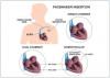 Photo for Global Cardiac Pacing Market 2020 | Manufacturers Regions Type And Application Forecast To 2025